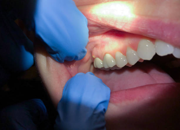 Best Chipped Tooth Repair Near Me  in Nazareth College, NY